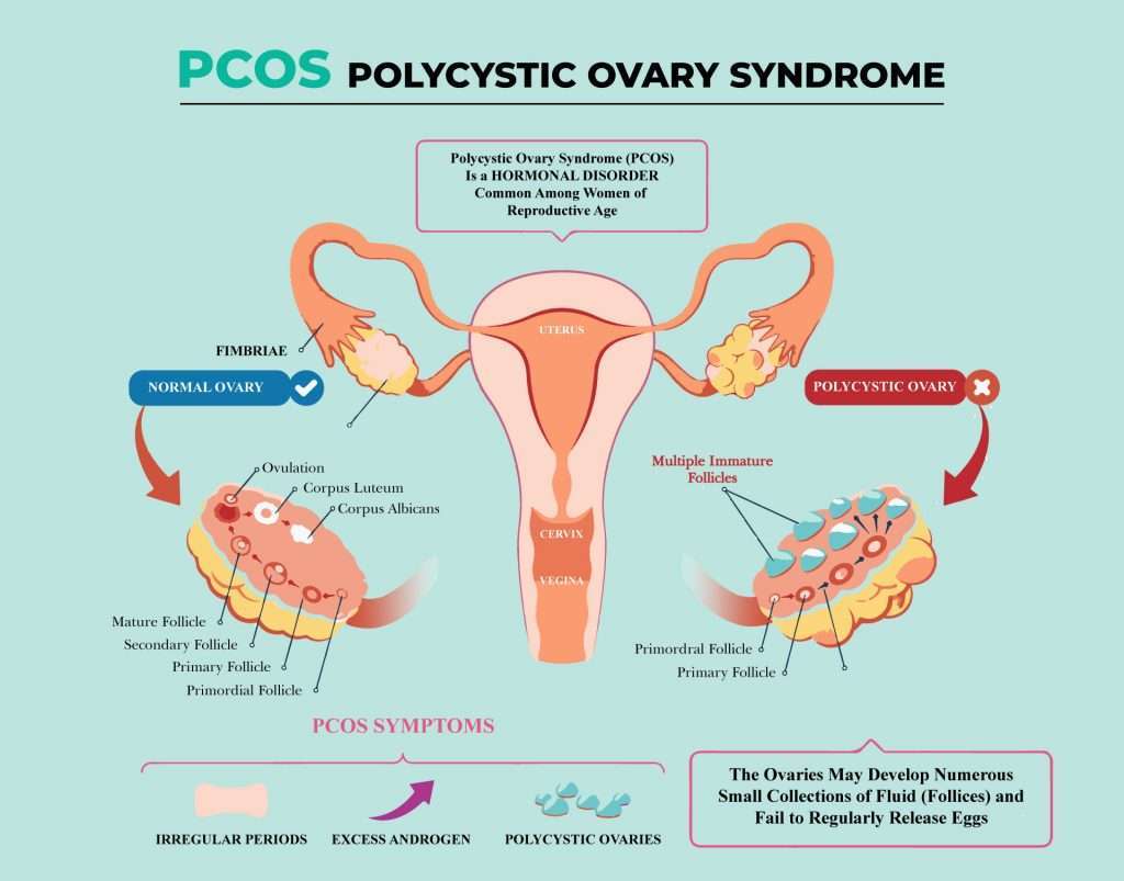 PCOS symptoms and what it is