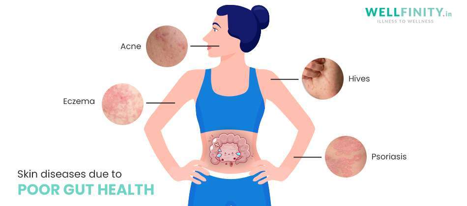 Skin issues due to poor gut health - Wellfinity.in