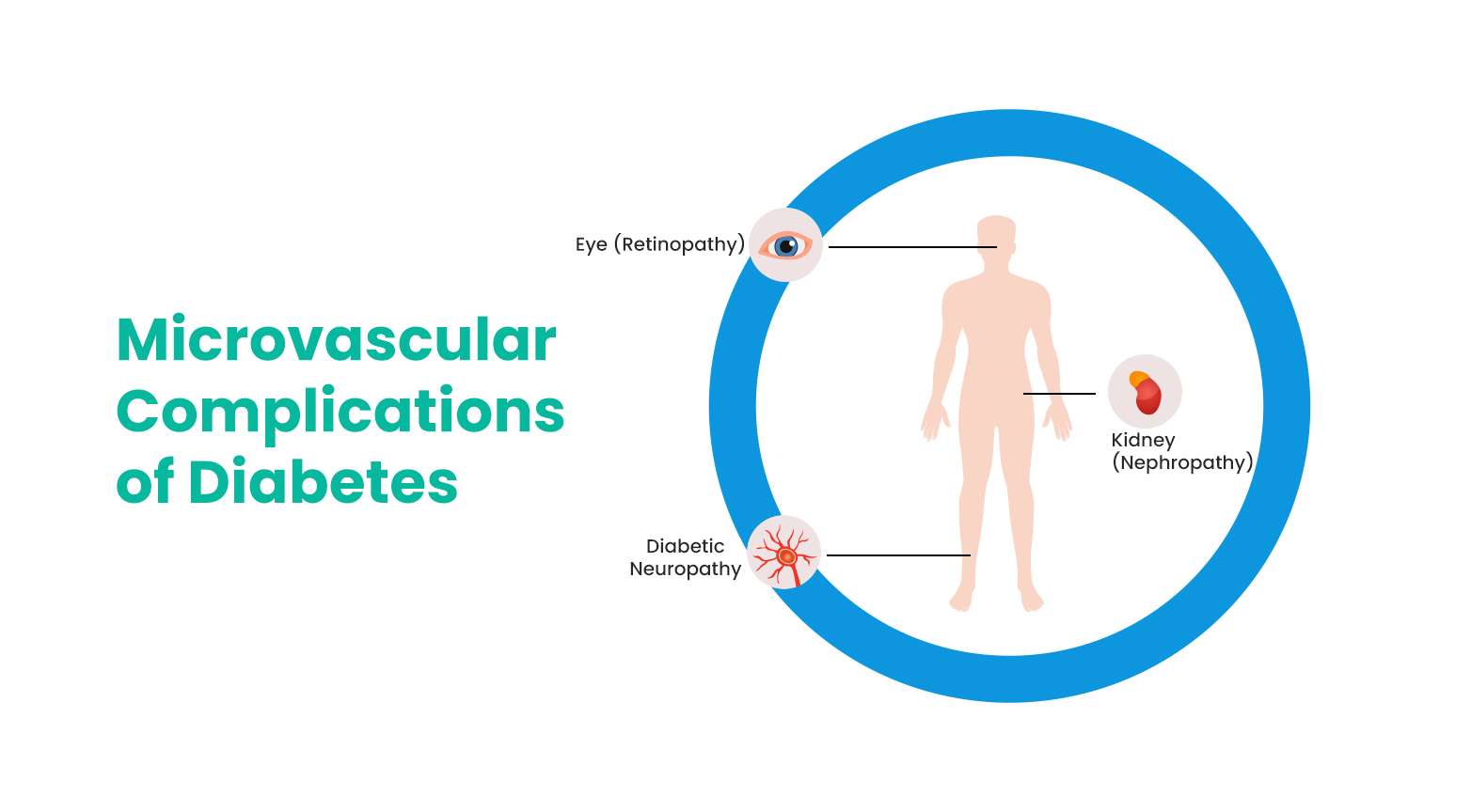 Microvascular Complications of Diabetes - Wellfinity.in