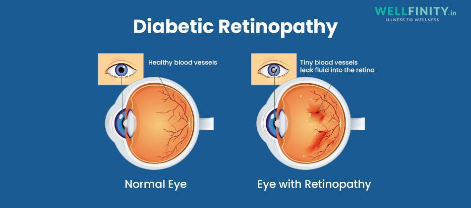 Diabetic retinopathy infographic - Wellfinity.in