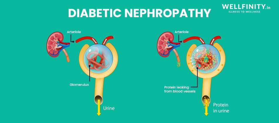 Diabetic Nephropathy Infographic - Wellfinity.in